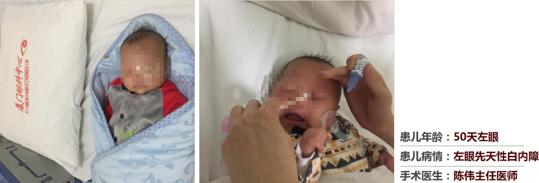 患兒年齡：50天左眼，患兒病情：左眼先天性白內障，手術醫(yī)生：白內障科陳偉主任醫(yī)師