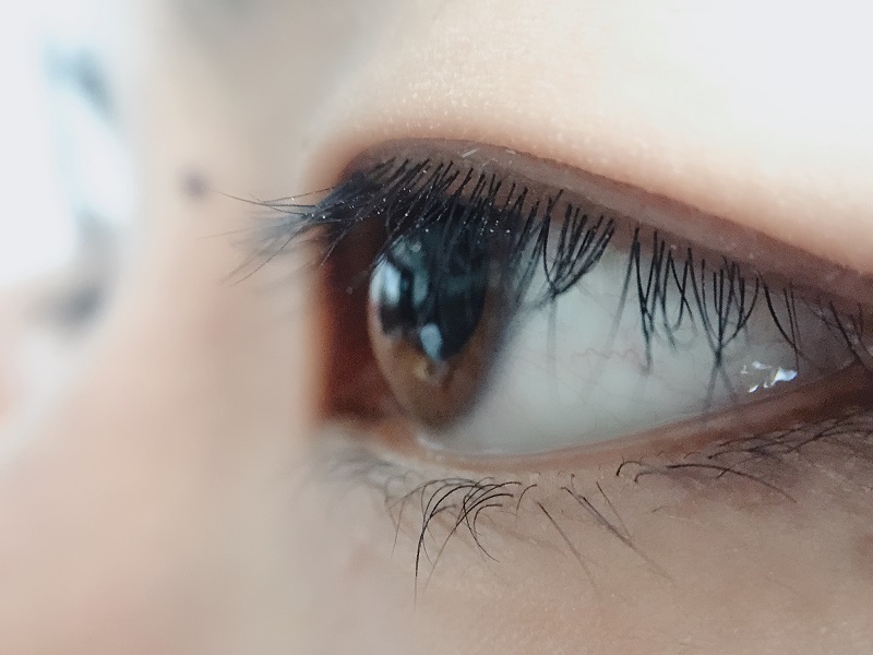 上眼皮為什么會(huì)下垂？上瞼下垂是怎么引起的？