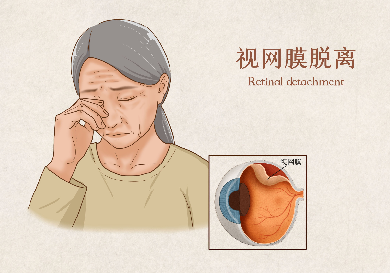 視網膜脫落能治好嗎